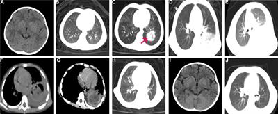 Case report: A rare case of pulmonary mucormycosis caused by Lichtheimia ramosa in pediatric acute lymphoblastic leukemia and review of Lichtheimia infections in leukemia